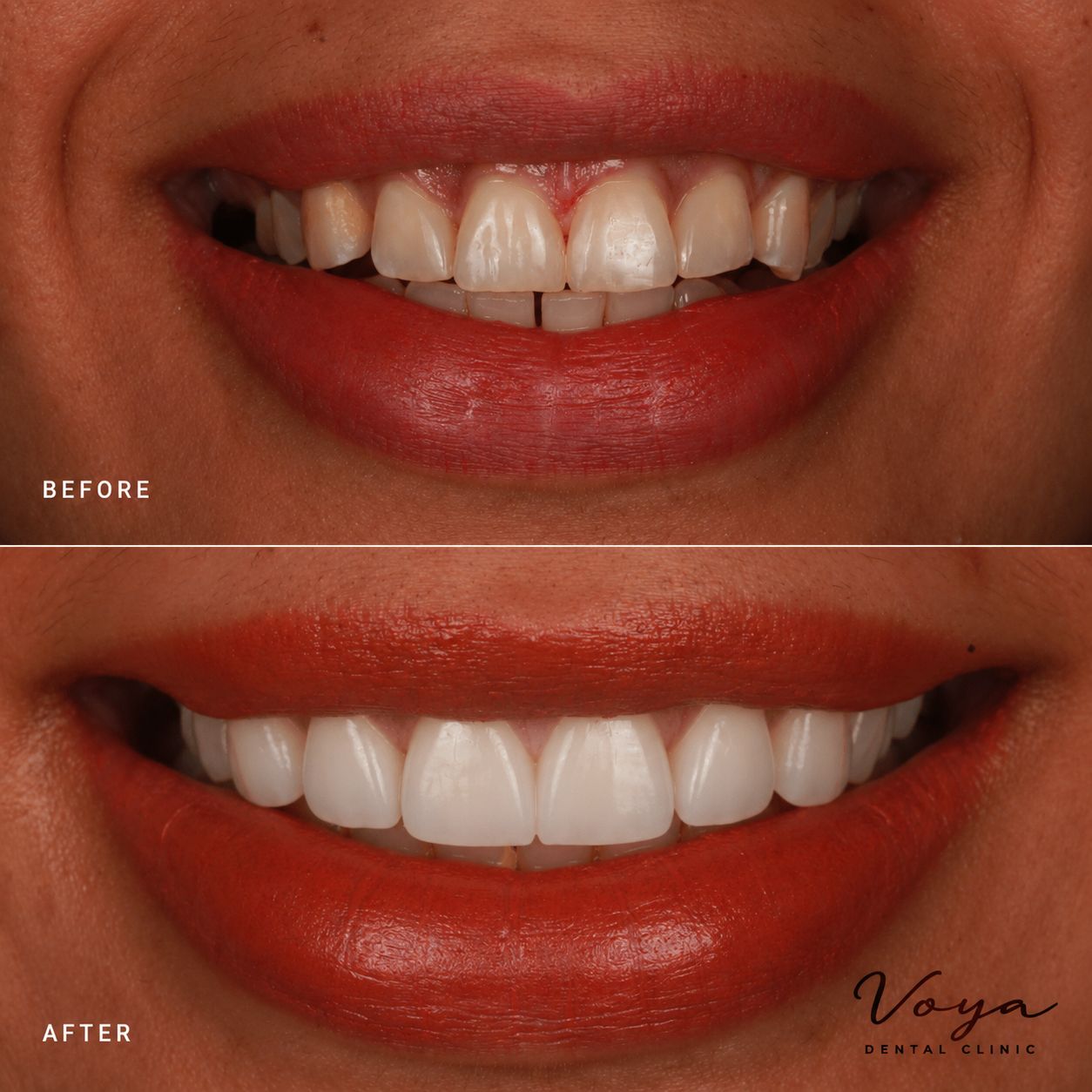 Best Composite Veneers Hurghada
